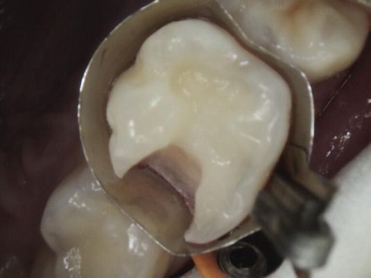Reconstrucción dental