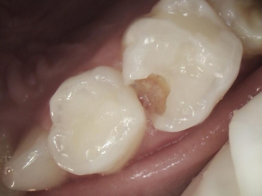 Reconstrucción dental
