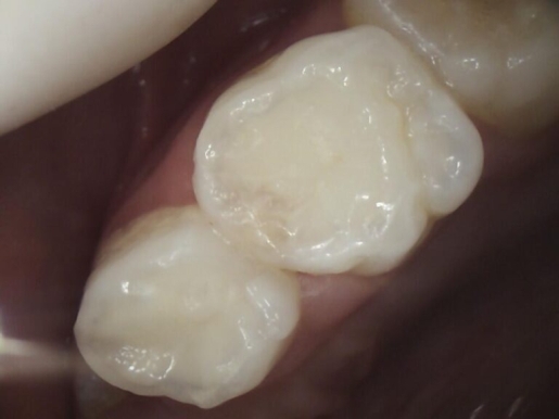 Reconstrucción dental