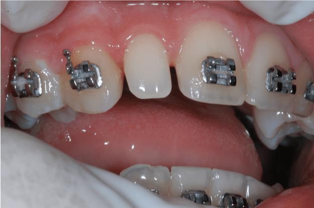 esthetic restoration