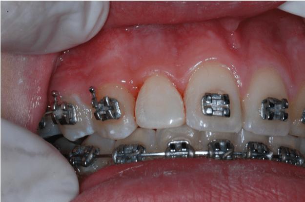 Esthetic restoration