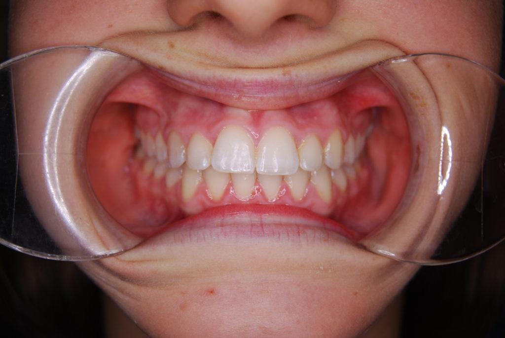 malocclusion after