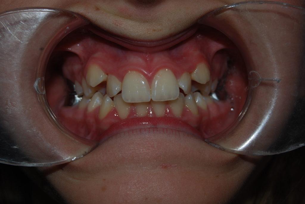 malocclusion before