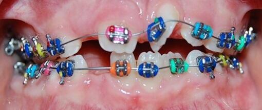 Brackets en niños y jóvenes