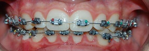 Brackets en niños y jóvenes