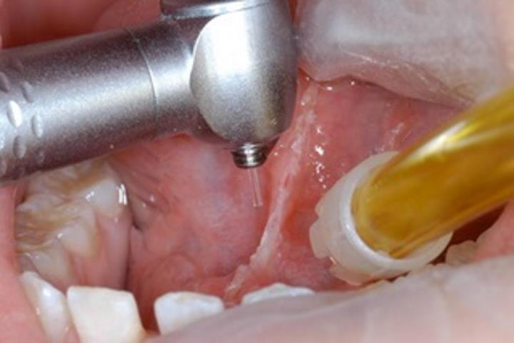 Cirugía dental