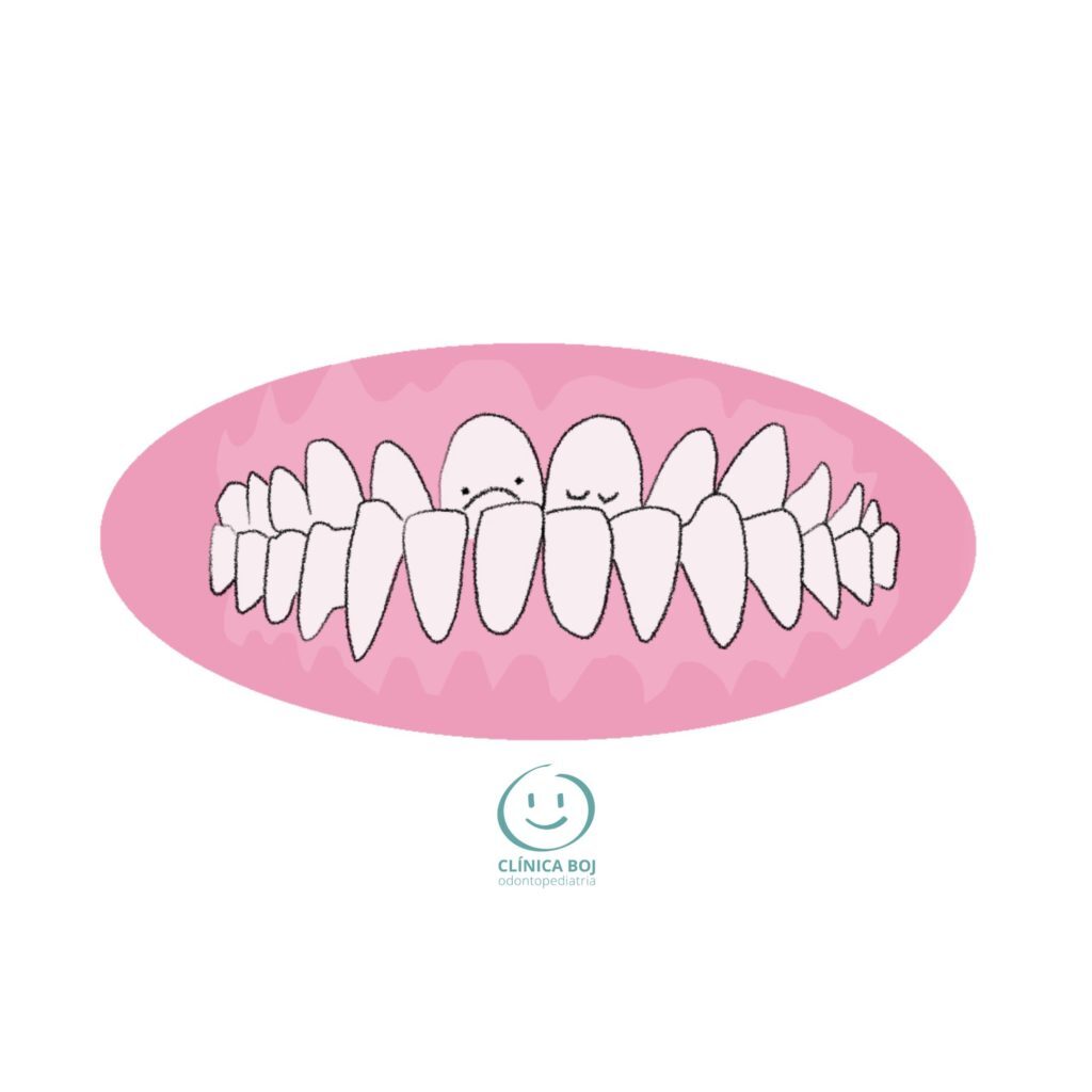 Anterior crossbite