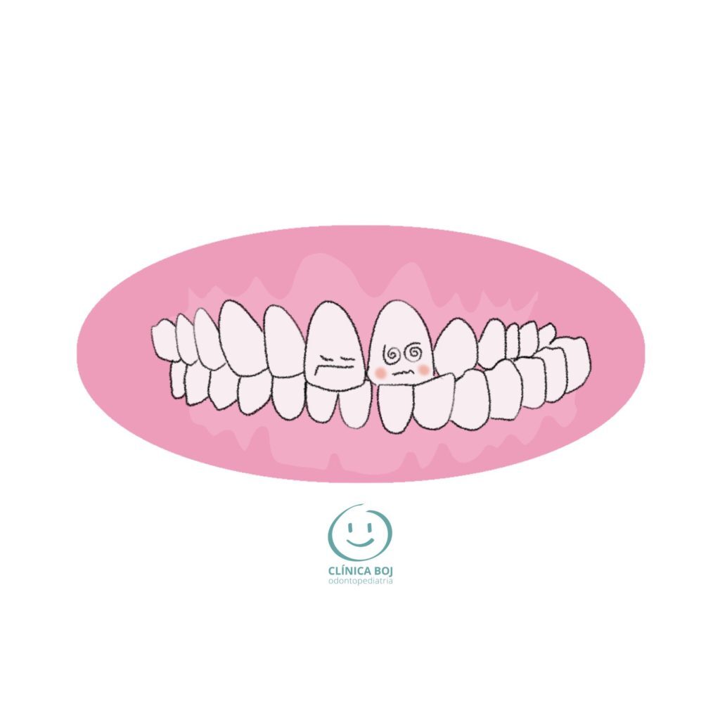 Posterior crossbite