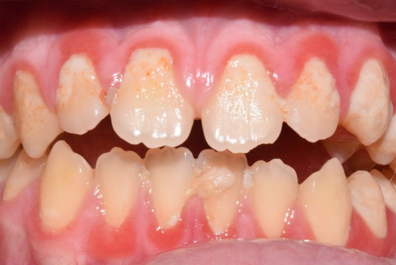 gingivitis aguda