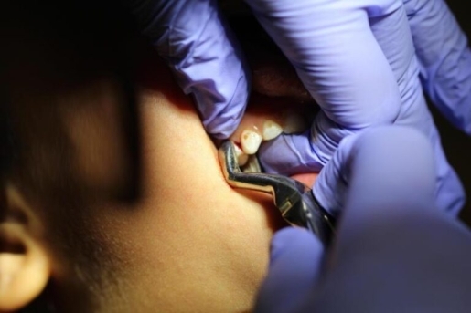 Tooth extraction