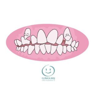 dental crowding