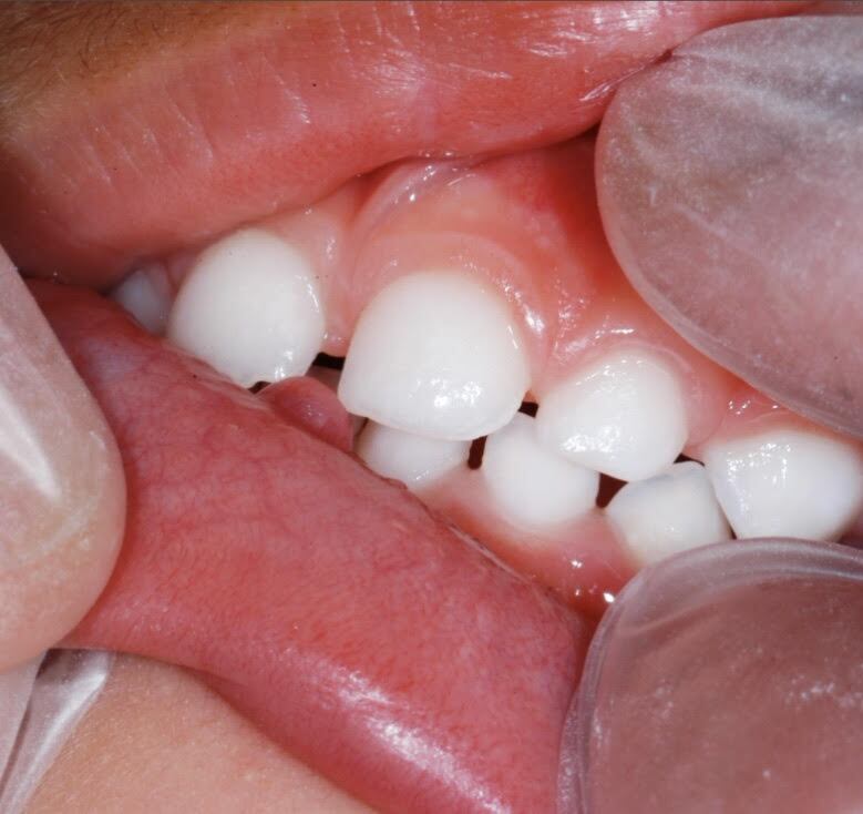 Mucocele antes