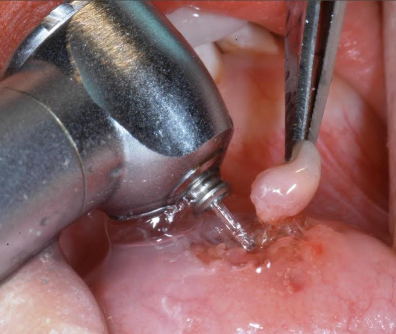 Mucocele bucal tratamiento