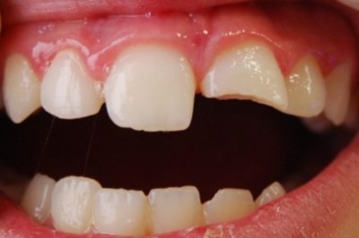 Luxació o desplaçament dental infantil Luxació o desplaçament dental infantil