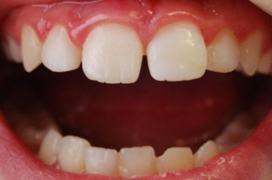 Avulsió dental Avulsió dental