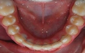 Lingual braces