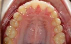Appliances to correct the jaw