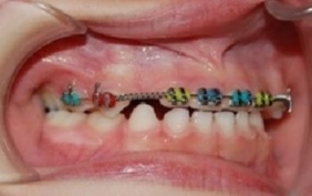 Orthodontics with braces