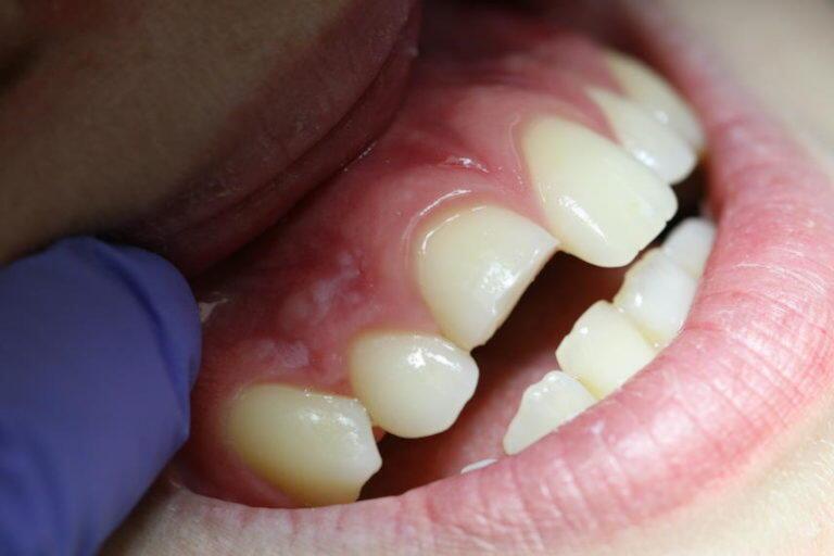 Dental dislocation or displacement