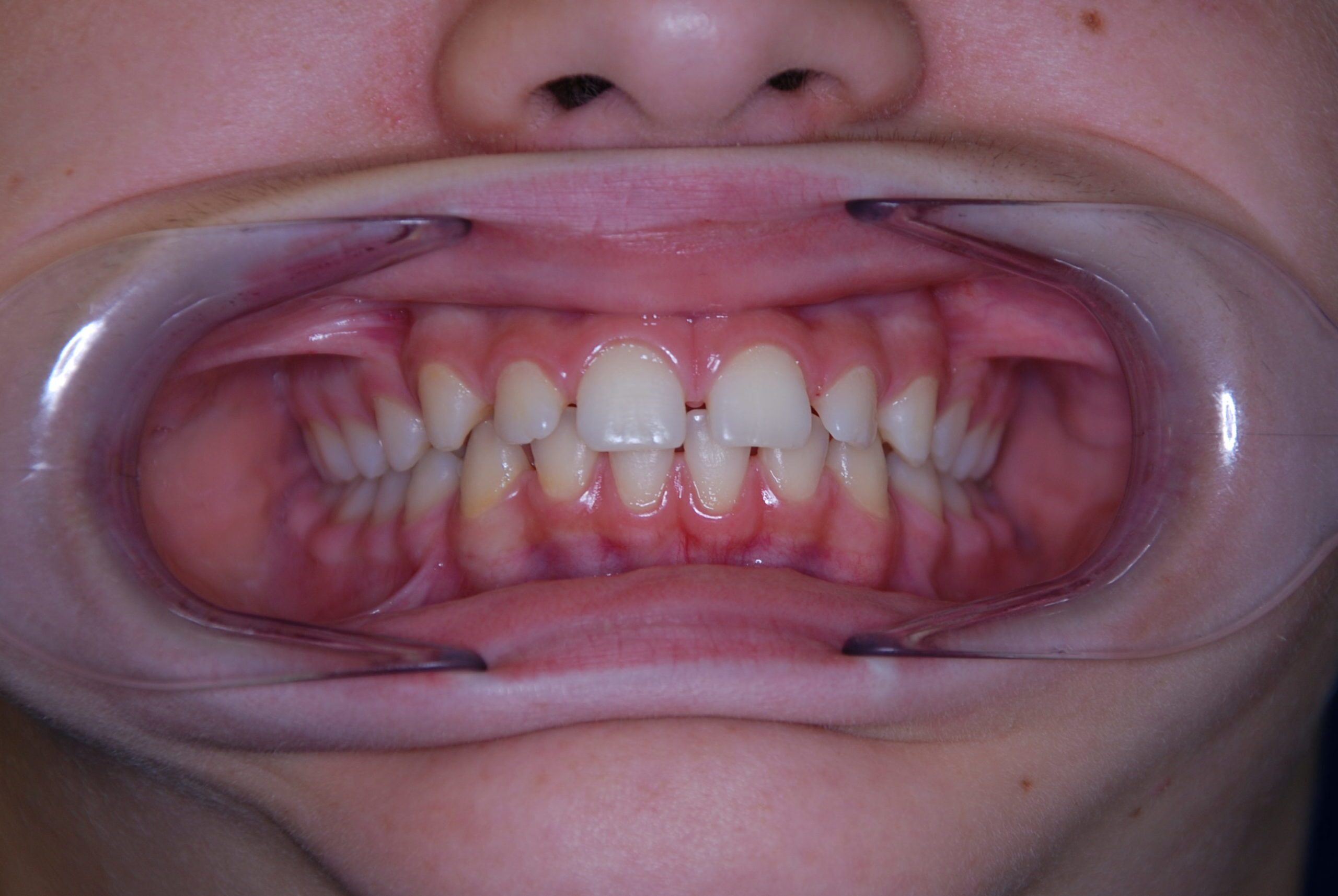 close diastema without braces