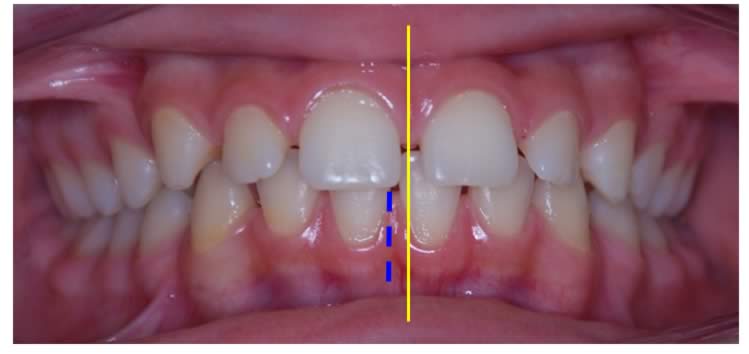 diastema