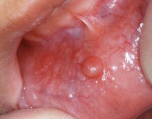 Mucocele labial